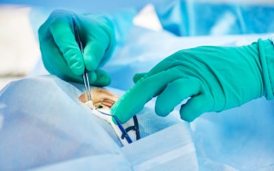 The Patient Journey of EVO ICL Surgery in San Francisco, CA, and Lasting Results